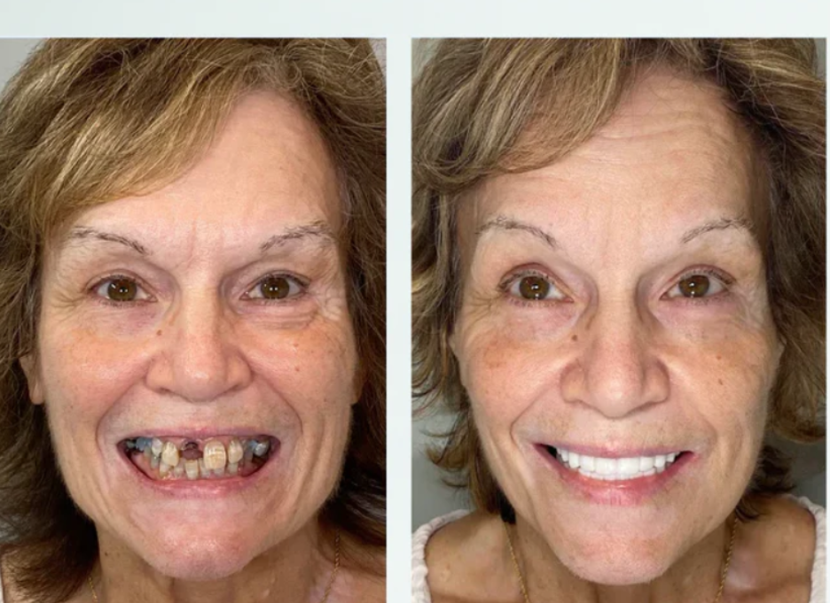 Tandfasader Bodyshaker