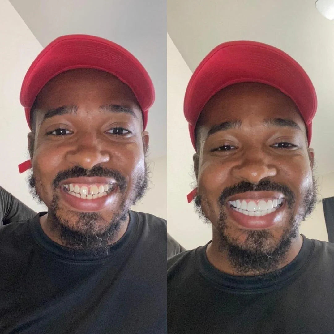 Tandfasader Bodyshaker